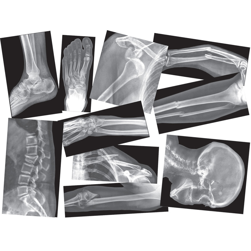 Broken Bones X-Rays